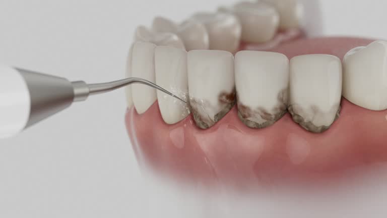 Reliable Dental Implants contractor in Deer Park, TX by Smile Center Dentistry